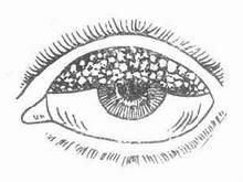 角鞏膜表層炎 角鞏膜表層炎