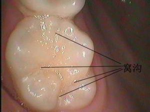 什麼是窩溝封閉 什麼是窩溝封閉