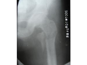 股骨粗隆間骨折