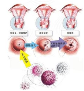 宮頸鱗狀細胞癌