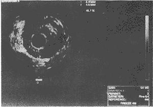 （圖）超聲心動圖查血流