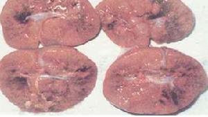 慢性腎小球性腎炎