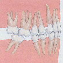 牙齒畸形
