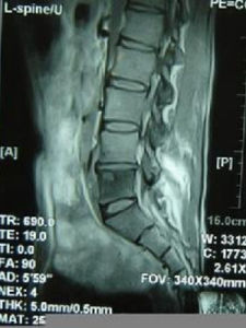脊柱結核 脊柱結核