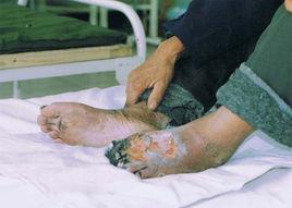 糖尿病末梢神經炎 糖尿病末梢神經炎