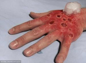 化學灼傷 化學灼傷