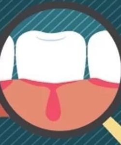 牙齦出血