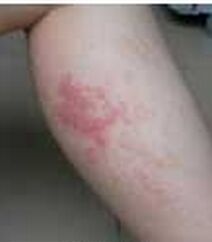 皮膚白血病 皮膚白血病