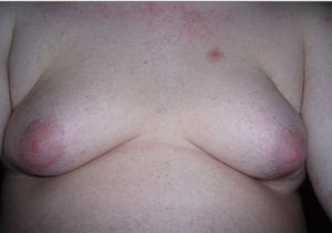 男性乳房發育症 男性乳房發育症