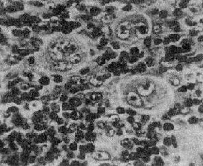 霍奇金病細胞圖