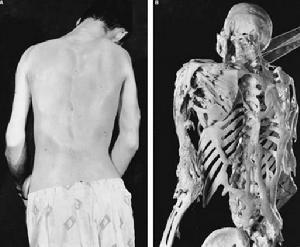 進行性骨化性肌炎