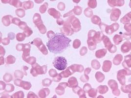 慢性嗜酸性粒細胞肺炎 慢性嗜酸性粒細胞肺炎