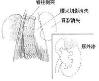 腎臟損傷 腎臟損傷