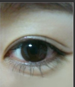 韓式微創雙眼皮