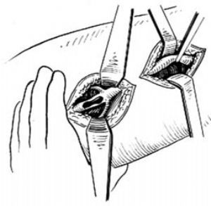 血管清創術 血管清創術