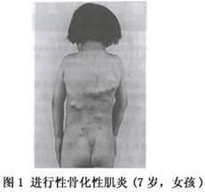 進行性骨化性肌炎