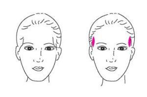 顳部填充術 顳部填充術