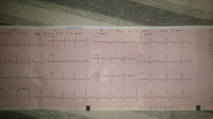 竇性心率不齊 竇性心率不齊