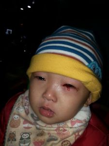 小兒結膜炎 小兒結膜炎