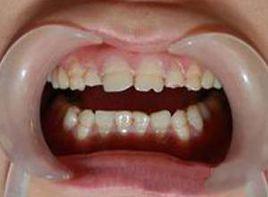 牙齒較小呈半透明狀 牙齒較小呈半透明狀