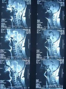 頸部平掃 頸部平掃