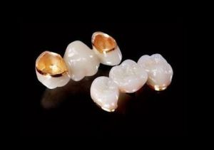 貴金屬烤瓷牙 貴金屬烤瓷牙