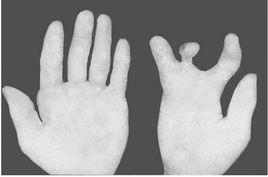 先天性缺指 先天性缺指