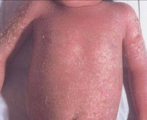 尋常型銀屑病 尋常型銀屑病