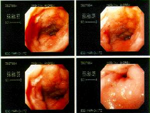 內視鏡觀察體內