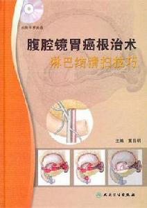 腹腔鏡胃癌根治術淋巴結清掃技巧