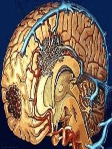 腦出血後遺症 腦出血後遺症