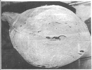 （圖）子宮腺肌病