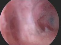 宮腔積膿 宮腔積膿