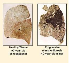 水泥塵肺 水泥塵肺