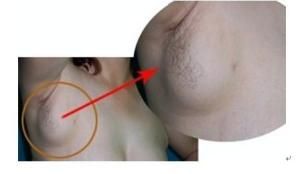 副乳乳腺癌 副乳乳腺癌