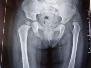 先天性髖關節脫臼 先天性髖關節脫臼