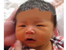 無膽色素尿性黃疸綜合徵 無膽色素尿性黃疸綜合徵