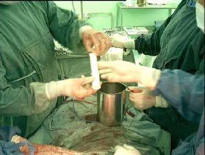 Α1抗胰蛋白酶缺乏性肝病