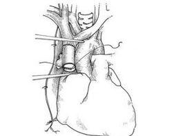 上腔靜脈回流受阻 上腔靜脈回流受阻