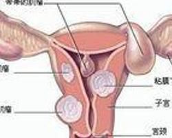 宮頸腫瘤 宮頸腫瘤