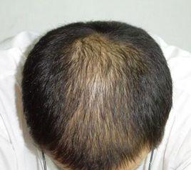 腎虛型脫髮 腎虛型脫髮