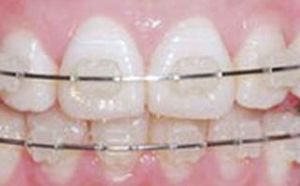 MBT直絲弓正畸技術