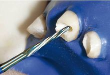 預成鑽製備根管