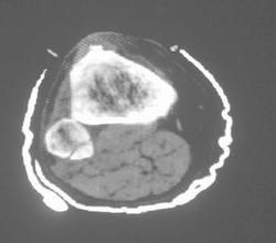 尤文肉瘤 尤文肉瘤