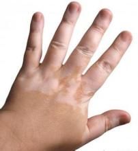 色素減退 色素減退