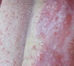 黏膜銀屑病 黏膜銀屑病