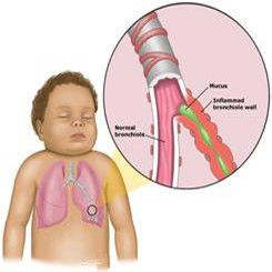 嬰幼兒支氣管炎
