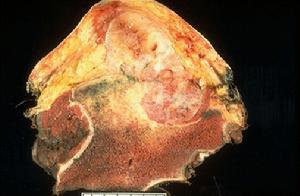 中心性軟骨肉瘤