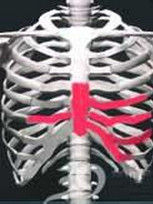 感染性肋軟骨炎 感染性肋軟骨炎