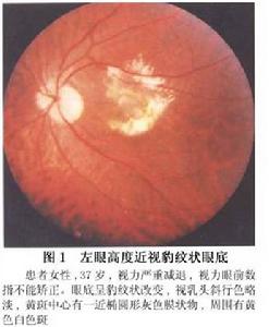 變性近視的脈絡膜萎縮